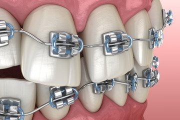 brackets dentales manizales