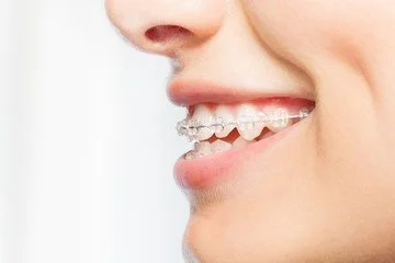 ortodoncia zafiro
